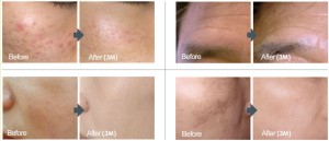 dermaroller facial before and afters